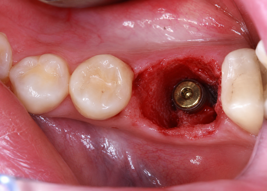 Implant dentaire posé immédiatement après une extraction