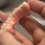 Prothèse transvissée en résine hybride céramique