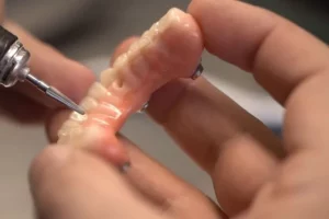 Prothèse transvissée en résine hybride céramique