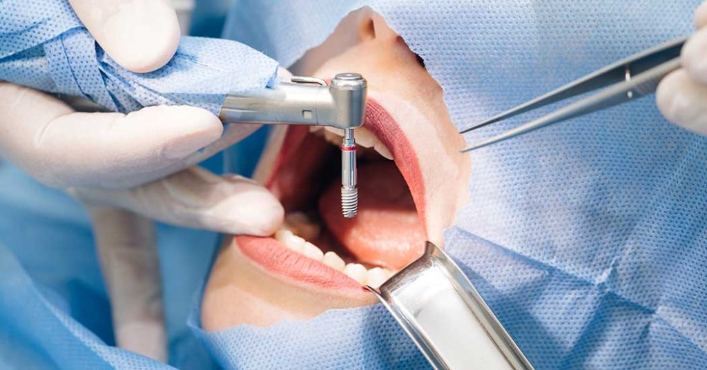 Retirer Un Implant Dentaire Prix