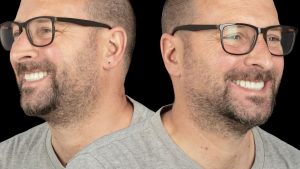 All-On-4 5 Patient Roumanie