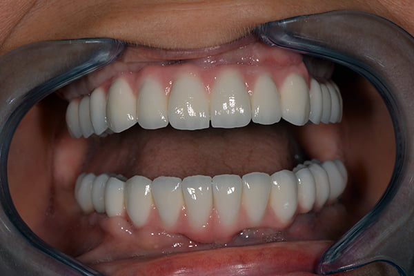 Implants dentaires,Implants dentaires à l'étranger