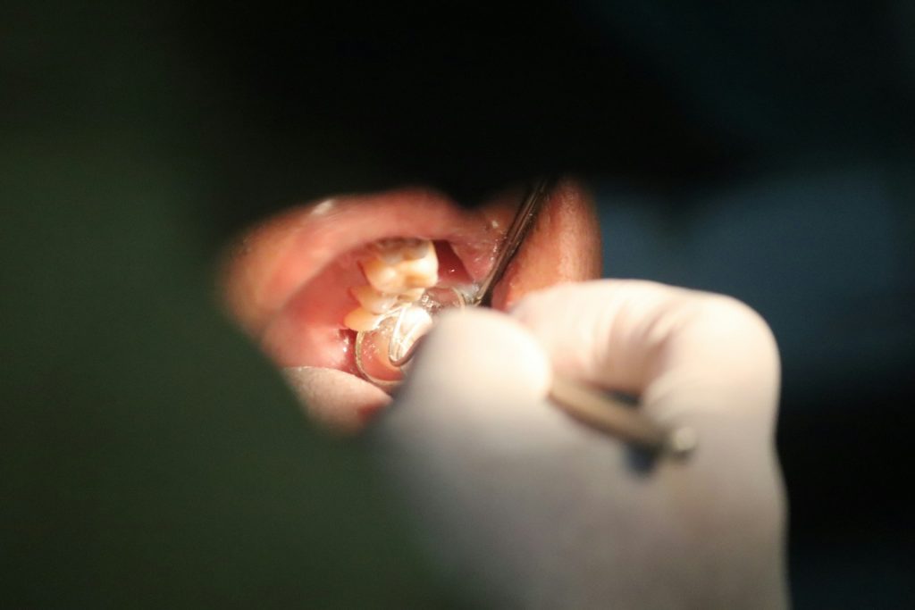 Risques d’une Carie Dentaire Non Soignée : Impact et Solutions