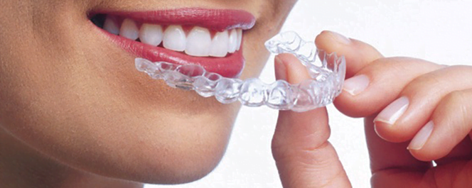 Invisalign pour les dents