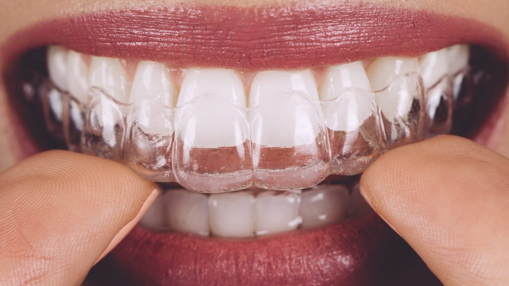 Invisalign