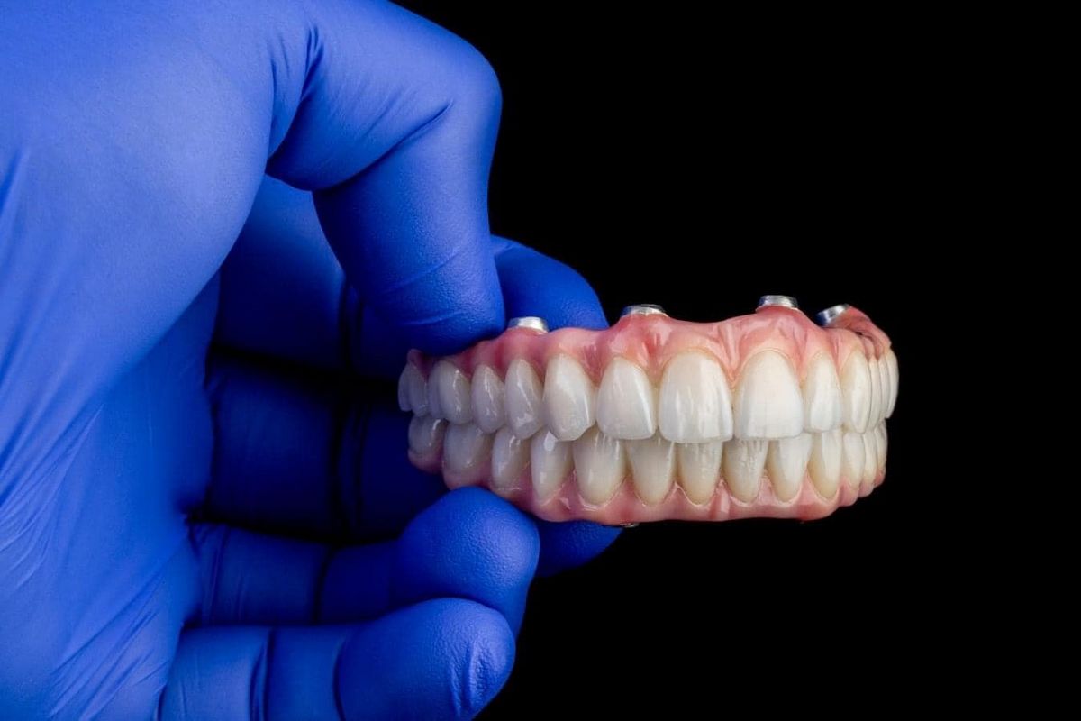 Prix implant dentaire Portugal : comprendre, comparer et économiser avec Dentaire Futé 2 Prix All-on-4 et 6 Portugal