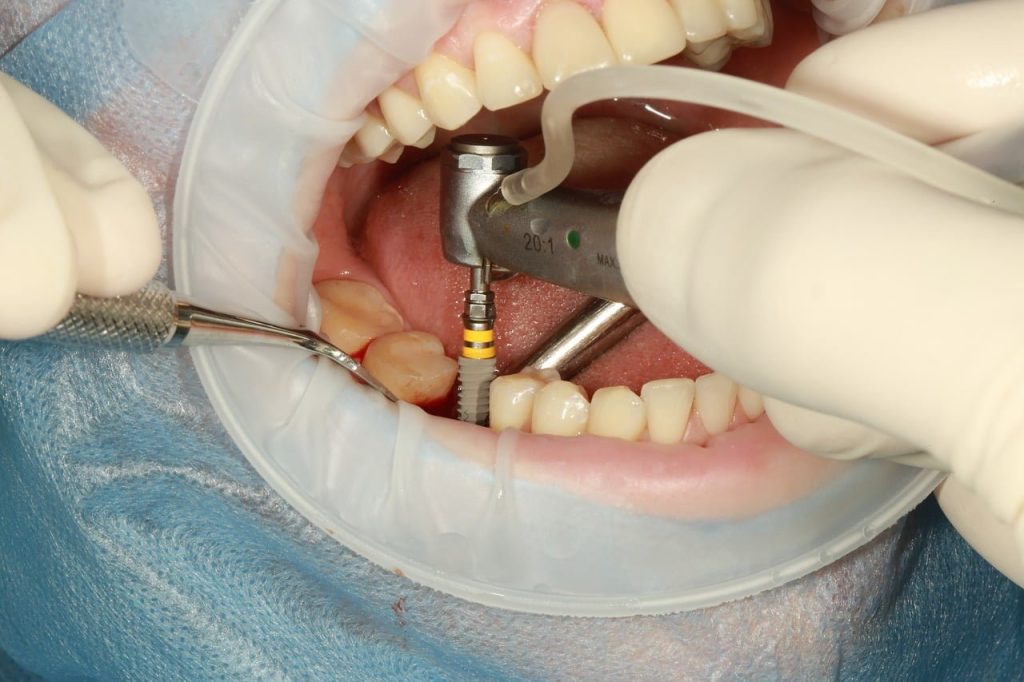 implant dentaire avant 