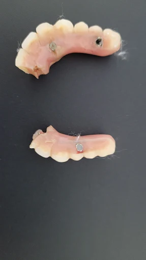 Prothèse dentaire cassée non conforme après traitement à l’étranger Clinique dentaire Santa Catarina