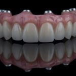 durée de vie d’un implant dentaire