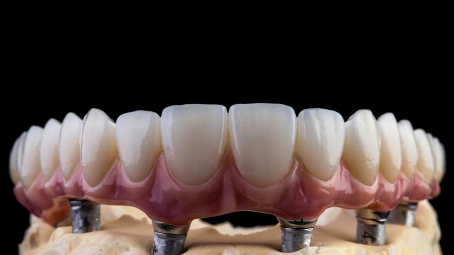 Entretien optimal des implants dentaires All-on-6 1 All-On-6