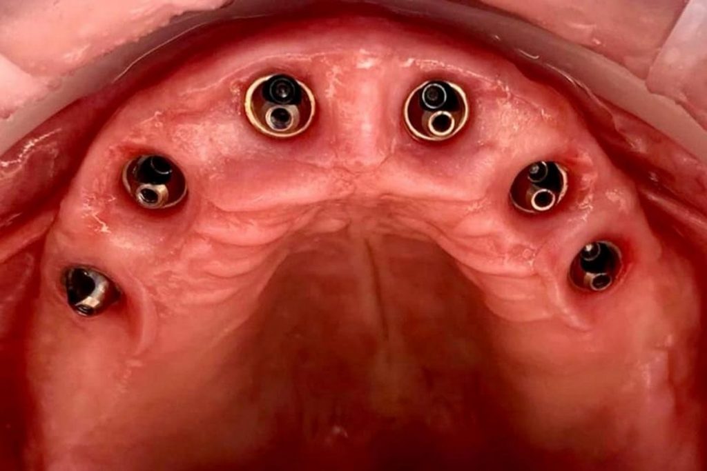 Entretien optimal des implants dentaires All-on-6 3 All-on-6 Implants