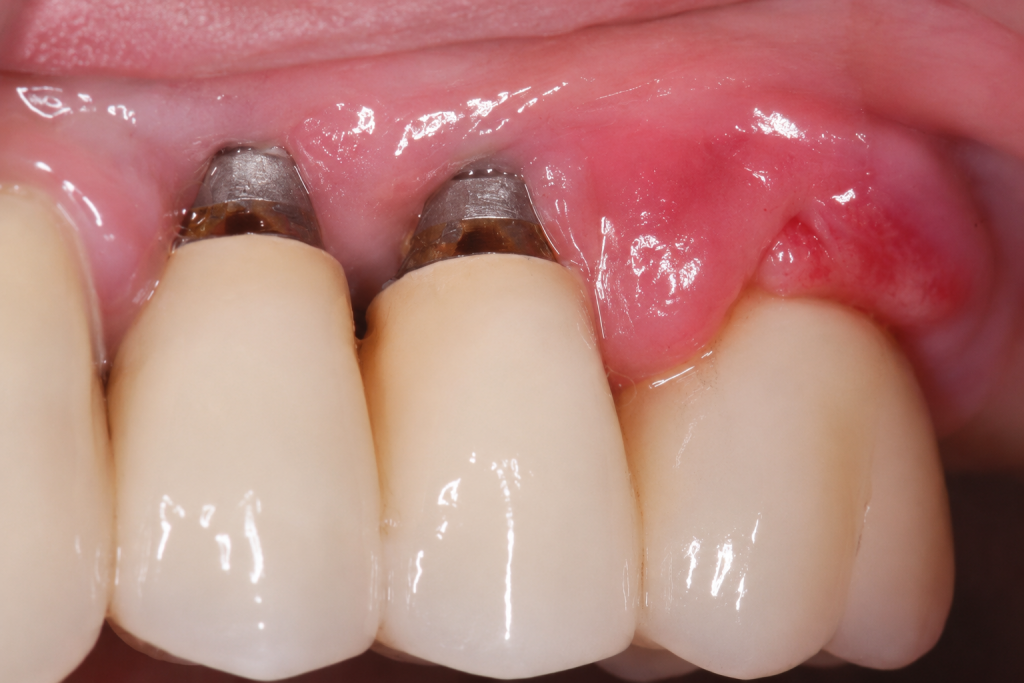 Péri-implantite avec inflammation autour d’un implant dentaire