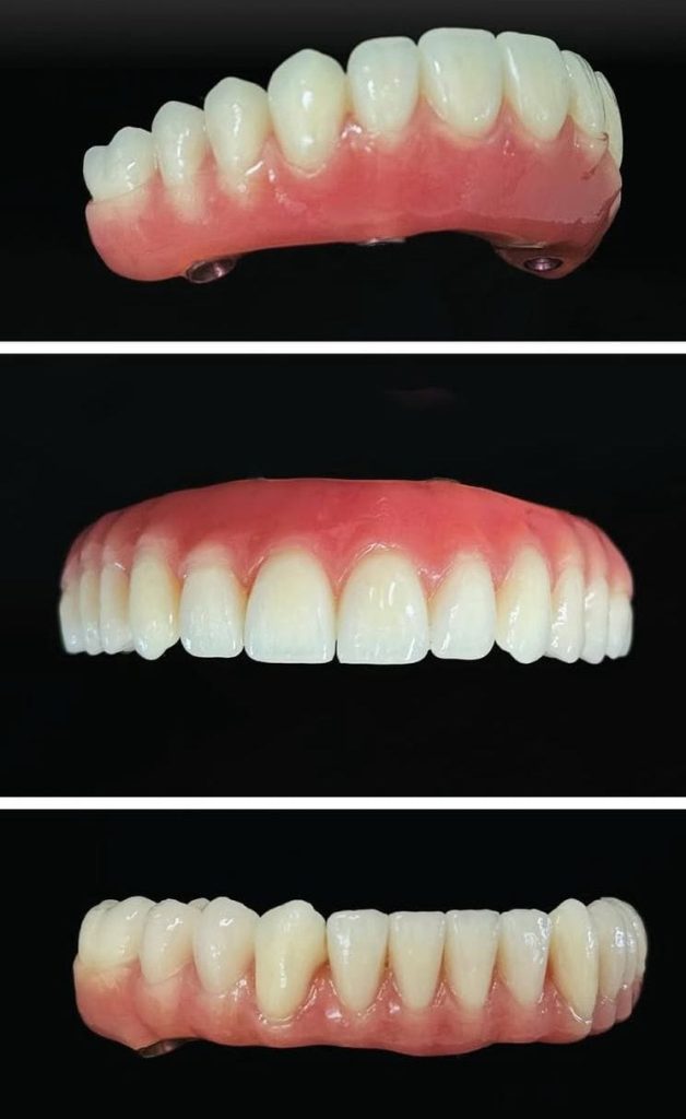 Prothèse dentaire provisoire en résine utilisée avant la pose d’un bridge définitif sur implants