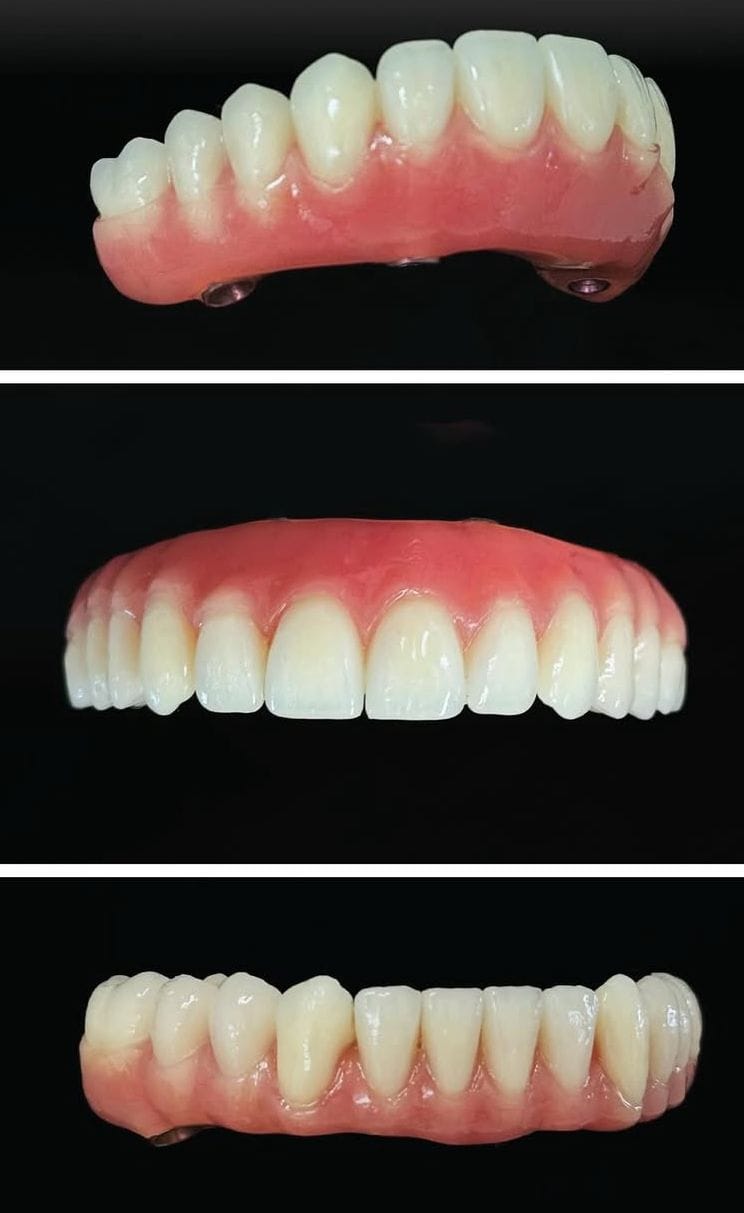 Prothèse acrylique