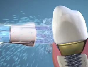 jet dentaire pour nettoyage implants