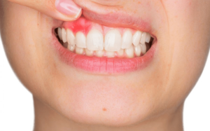 All-On-4 4 paradontite