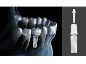 All-On-6 4 implants dentaire modele