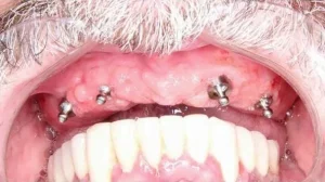 combien de temps pour poser implant dentaire