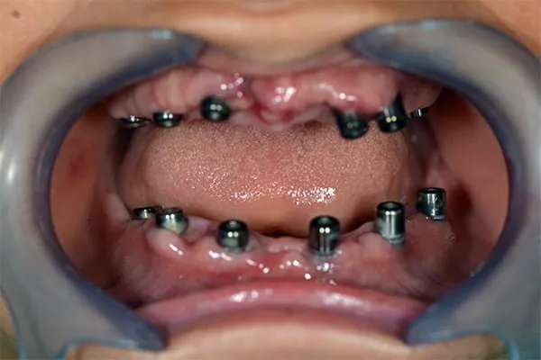 All-On-6 2 all-on-6-cas-clinique-avant