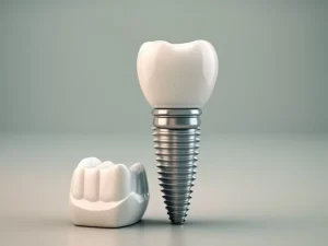 Implants Dentaires 5 Économisez 60 % sur vos implants dentaires grâce au tourisme dentaire !