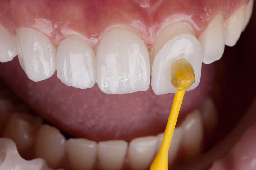 Facettes dentaires Veneers