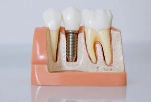 implants dentaires bioactifs