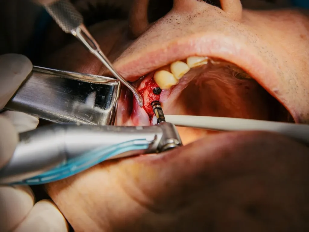 Implant dentaire : tout savoir avant de se lancer 2 Douleurs post-opératoires après la pose d'un implant dentaire