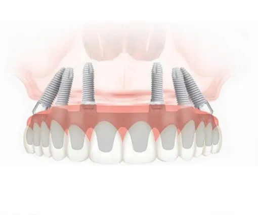 Fourchette de prix 2025 : de l’implant unitaire aux protocoles All-on-4