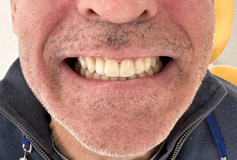 cicatrisation d'un implant dentaire