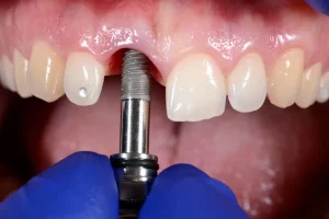 Temps de cicatrisation d'un implant dentaire