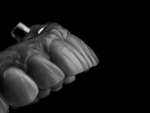 All-On-6 4 Prothèse cassée