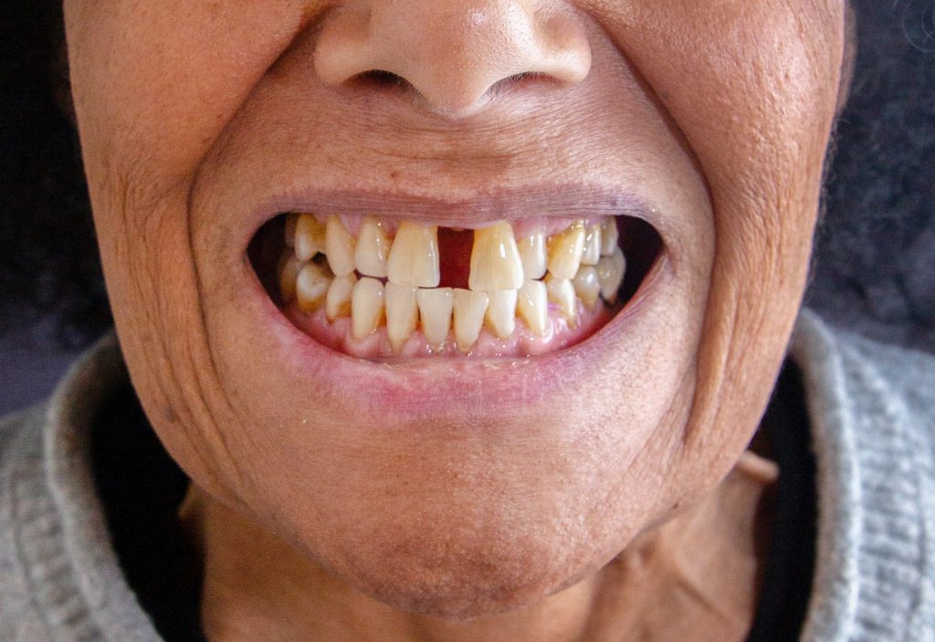 implant dentaire avant 