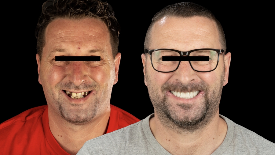 meilleurs implants dentaires