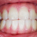 gingivite traitement prevention