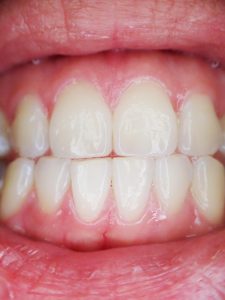 gingivite traitement prevention