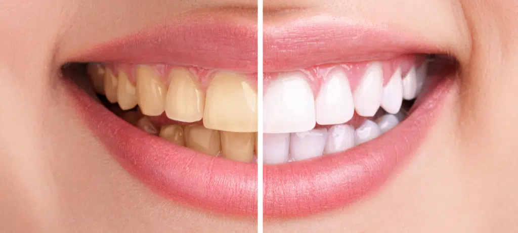 Quels kits de blanchiment dentaire à domicile sont efficaces et sécurisés ? 2 Blanchiment dentaire à domicile