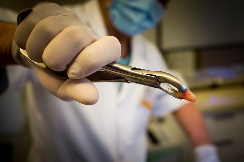 Carie dentaire extraction