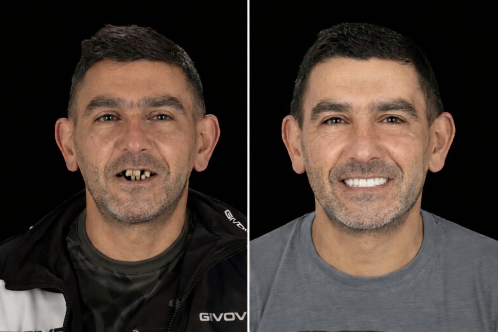 Alain, 53 ans, Hauts-de-France All-on-6