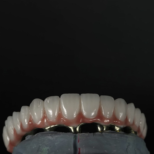 Prothèse implantoportée