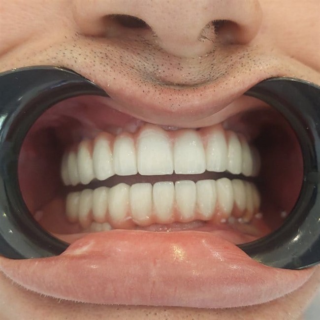 All-On-6 hybride résine