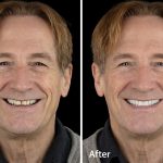 Témoignages patients implants