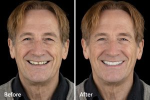 Témoignages patients implants