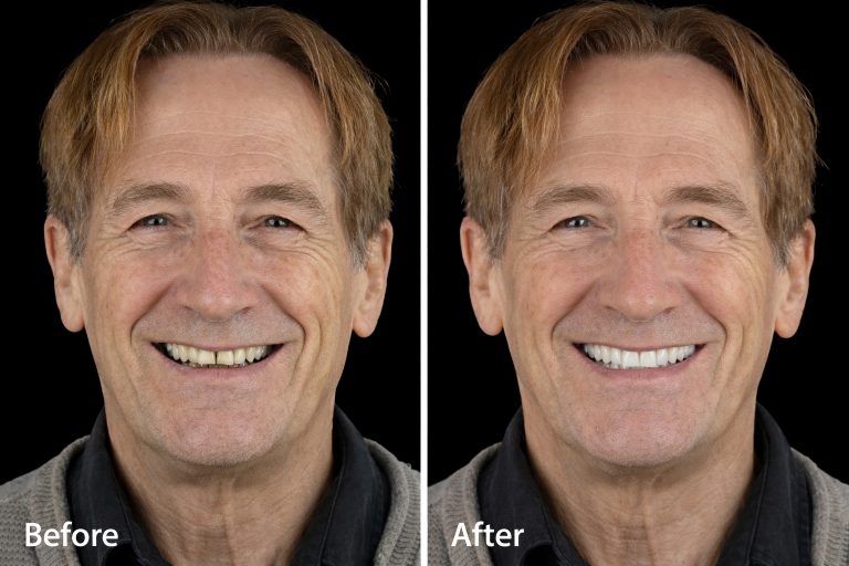 Témoignages patients implants