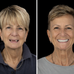 mise en charge immédiate vs mise en nourrice implant dentaire