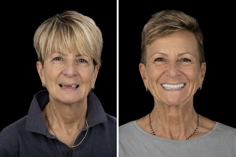 mise en charge immédiate vs mise en nourrice implant dentaire