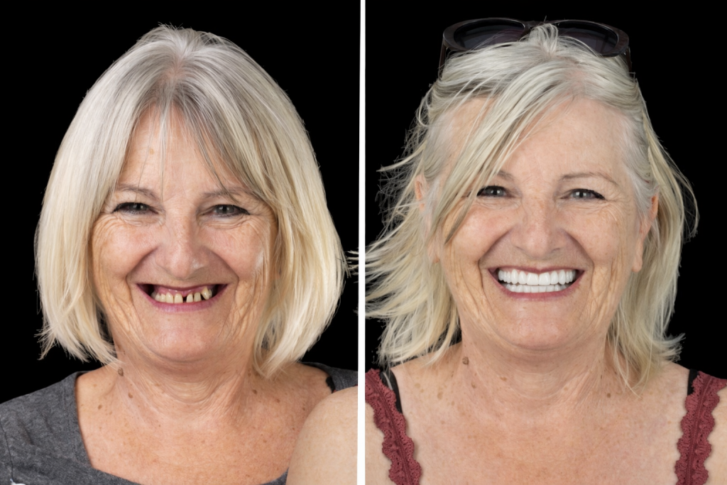 Avant après dents restaurées dans une clinique dentaire partenaire en Europe