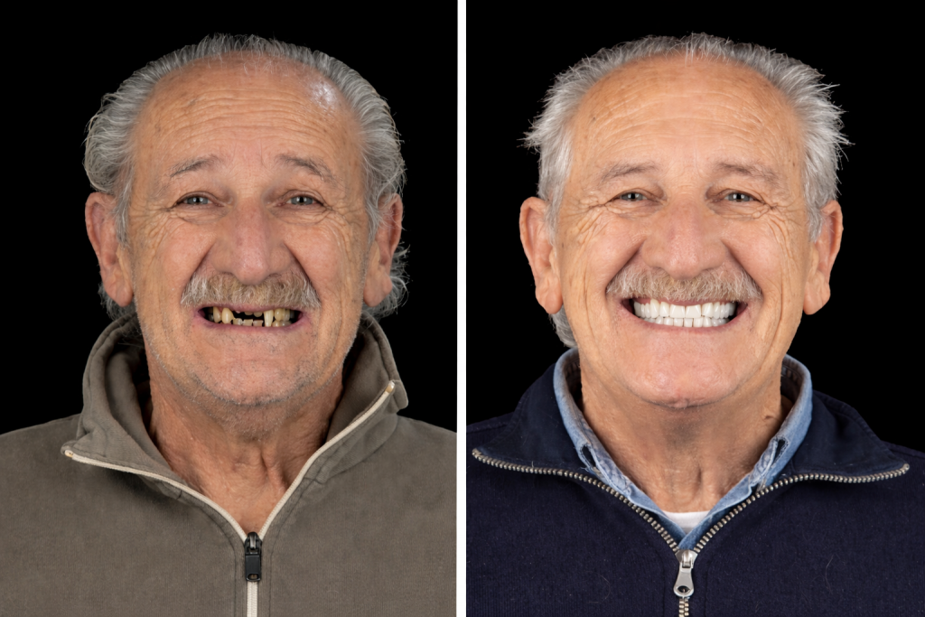 Avant après réhabilitation dentaire complète sur implants avec solution fixe