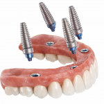 implant incline maxillaire All-on-4 schema