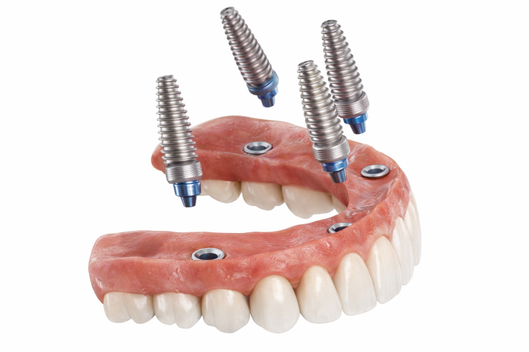 implant incline maxillaire All-on-4 schema