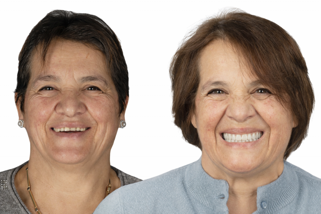 Tourisme dentaire avant après